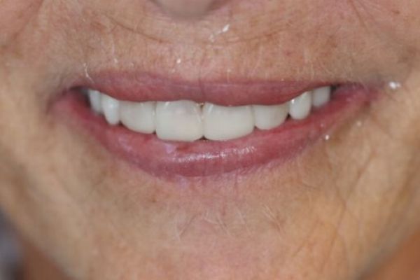 Porcelain Veneers Case 1 After