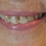 Porcelain Veneers Case 1 Before