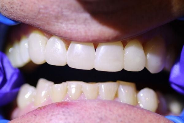 Porcelain Veneers Case 2 After