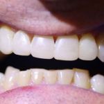 Porcelain Veneers Case 2 After
