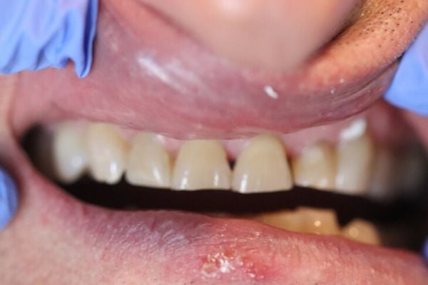 Porcelain Veneers Case 2 Before