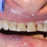 Porcelain Veneers Case 2 Before