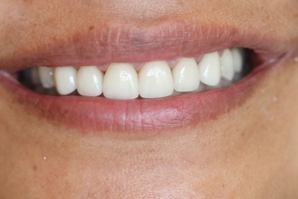 Porcelain Veneers Case 3 After