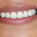 Porcelain Veneers Case 3 After