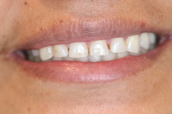 Porcelain Veneers Case 3 Before
