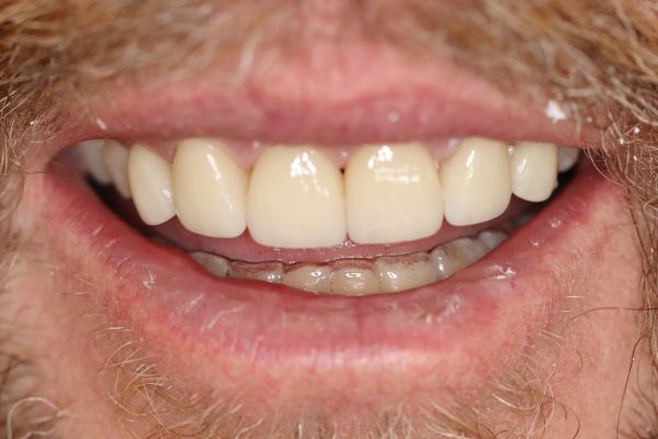 Porcelain Veneers Case 4 After
