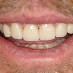 Porcelain Veneers Case 4 After
