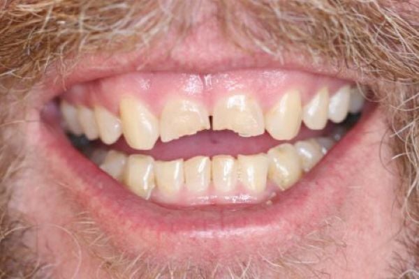 Porcelain Veneers Case 4 Before