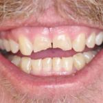Porcelain Veneers Case 4 Before