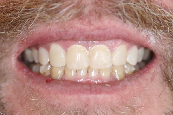 Porcelain Veneers Case 4 Mock-Up