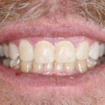 Porcelain Veneers Case 4 Mock-Up