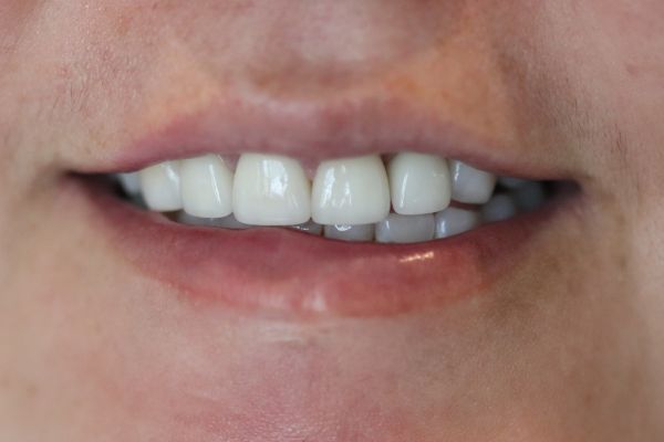Porcelain Veneers Case 5 After