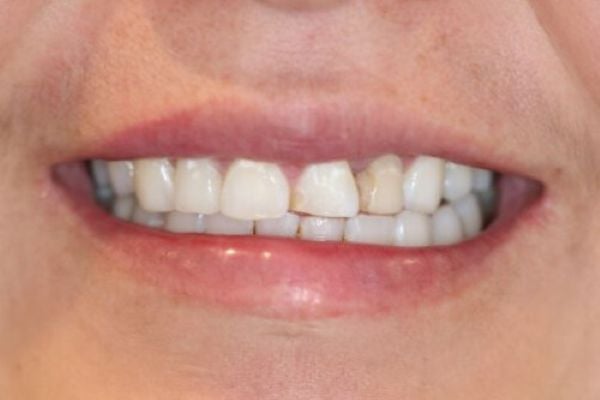 Porcelain Veneers Case 5 Before