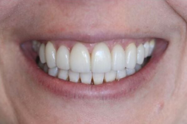 Porcelain Veneers Case 6 After