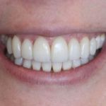 Porcelain Veneers Case 6 After