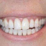 Porcelain Veneers Case 6 Before