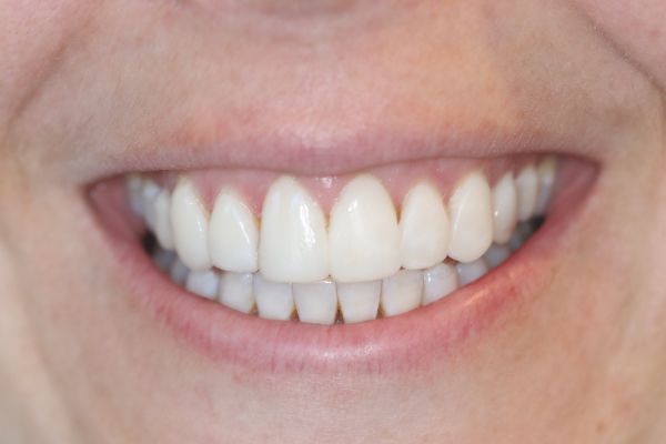 Porcelain Veneers Case 6 Mock-Up