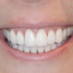 Porcelain Veneers Case 6 Mock-Up