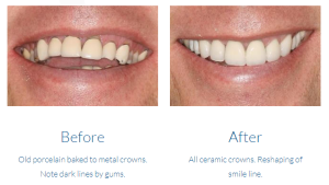 Case study 16: ceramic crowns before & after photos