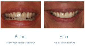 Case study 4: ceramic crowns before & after photos